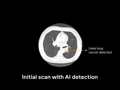 谷歌新的人工智能模型可以在CT掃描中檢測到肺癌