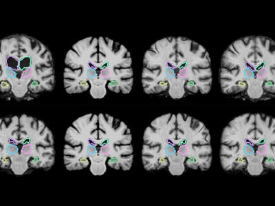 MIT开发了一种神经网络 可以在一秒内完成MRI扫描