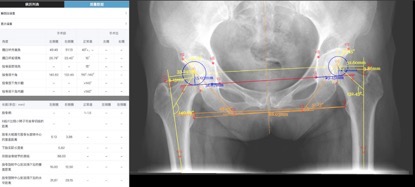 达摩院医疗AI解决骨科手术历史难题，0.3秒定位解剖位置