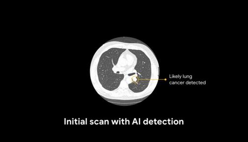 谷歌新的人工智能模型可以在CT扫描中检测到肺癌