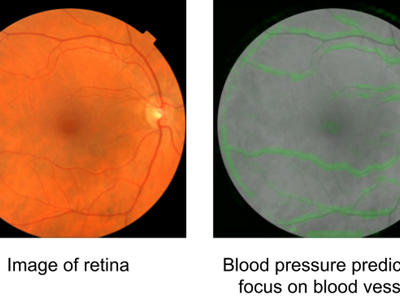谷歌AI可以通过眼部扫描预测心脏疾病风险